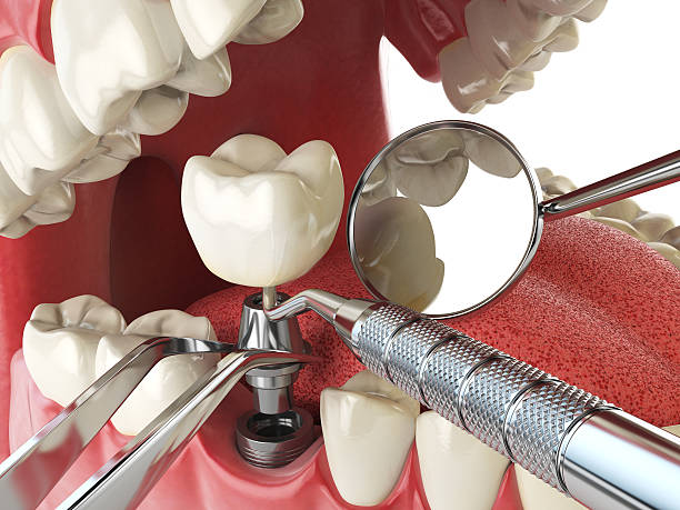 Best Emergency Tooth Extraction in Grass Valley, CA