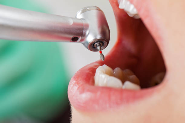 Best Emergency Tooth Extraction in Grass Valley, CA